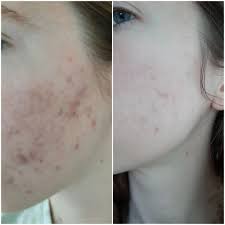 The Ordinary Glycolic Exfoliating Toner , Peeling Solution, Niacinamide