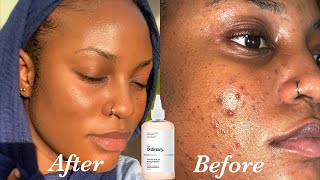 The Ordinary Glycolic Exfoliating Toner , Peeling Solution, Niacinamide
