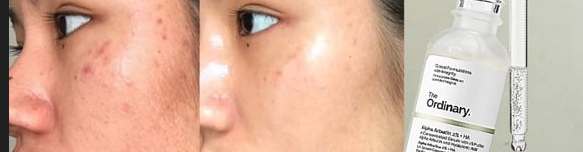 The Ordinary Glycolic Toning Solution 7% | Natural Moisturizing Factors + HA | Alpha Arbutin 2%+ HA