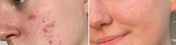 The Ordinary Glycolic Exfoliating Toner , Peeling Solution, Niacinamide